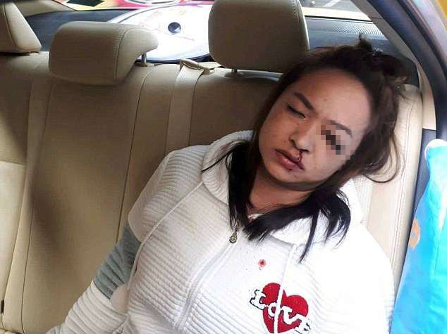 Hành khác nữ vô tình bị chiếc bút chỉ đâm vào chọc mắt