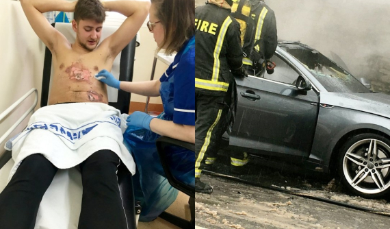 Bút vape phát nổ trong túi áo khiến tài xế bị bỏng nặng và chiếc Audi A5 bị thiêu rụi