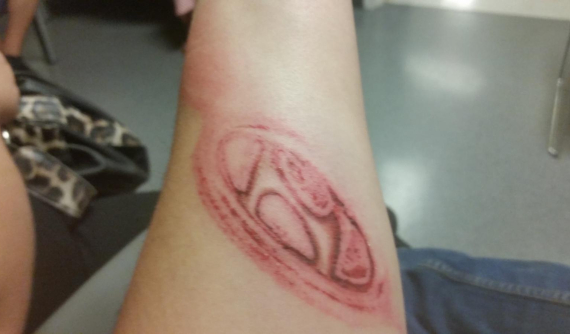 Túi khí nổ khiến tay người lái xuất hiện vết thương hình logo xe