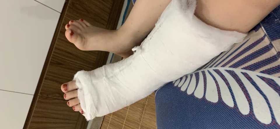Hậu quả làm chân trái bị chấn thương, phải bó bột Hậu quả làm chân trái bị chấn thương, phải bó bột